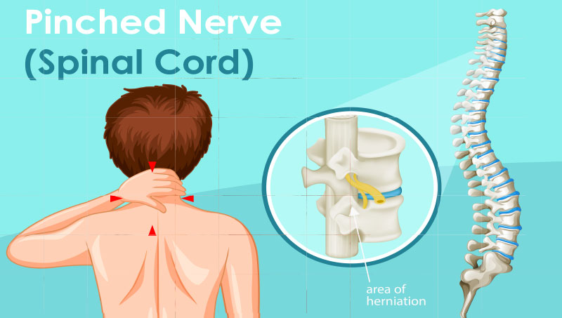Diagram explaining pinched nerves